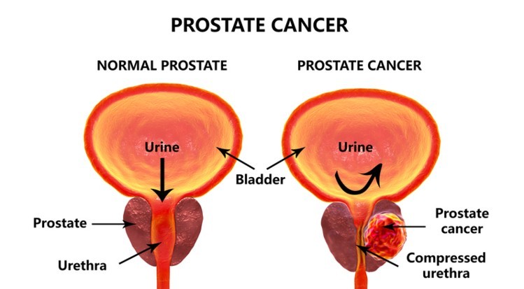 Selenium kills Prostate Cancer